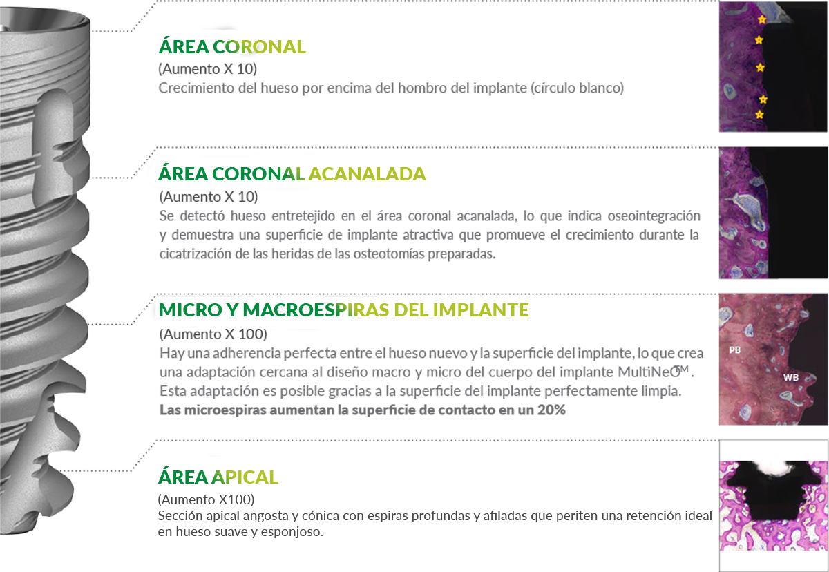 Las partes del implante MultiNeO