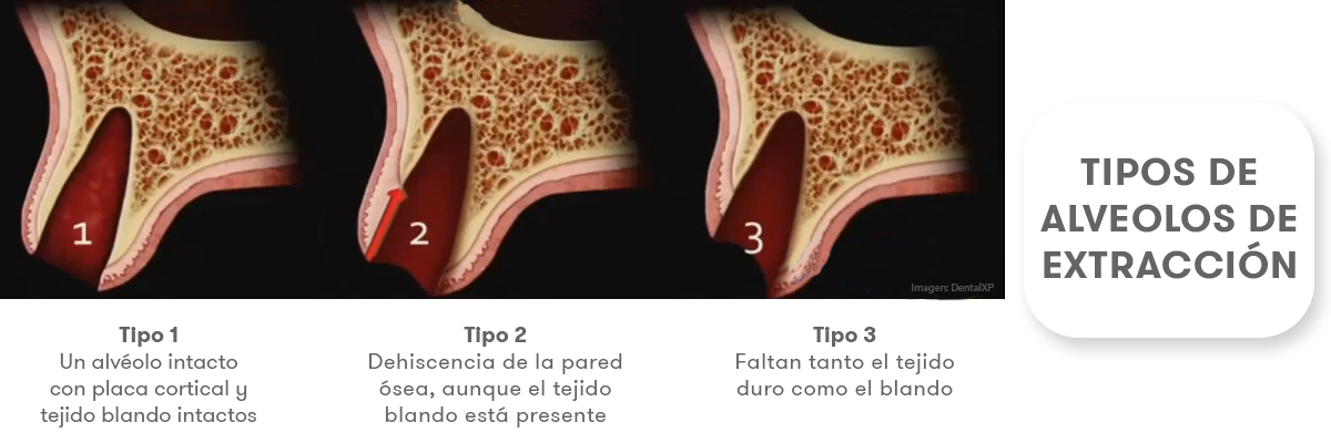 Preservar los tejidos según el tipo de alveolo