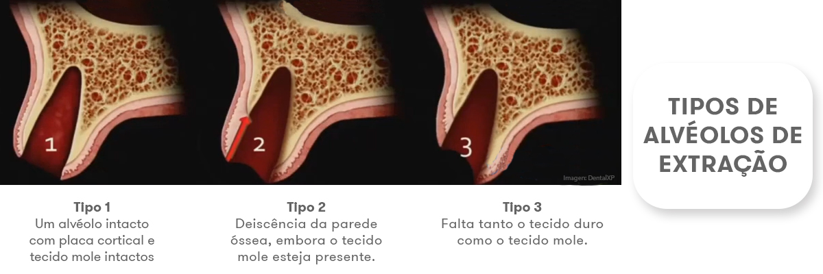 Tipos de alvéolos de extração