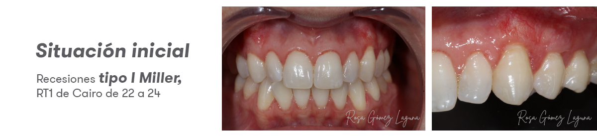 Imagem 1 do caso clínico de micro-acesso apical