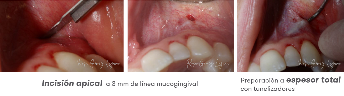 Imagem 3 do caso clínico de microacesso apical.