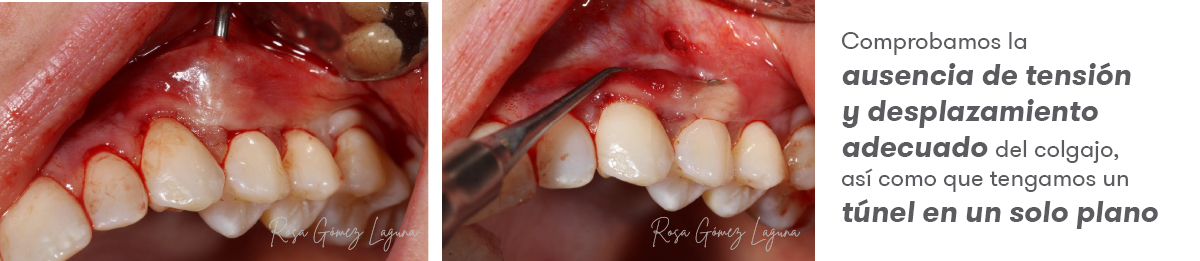 Imagem 4 do caso clínico de microacesso apical