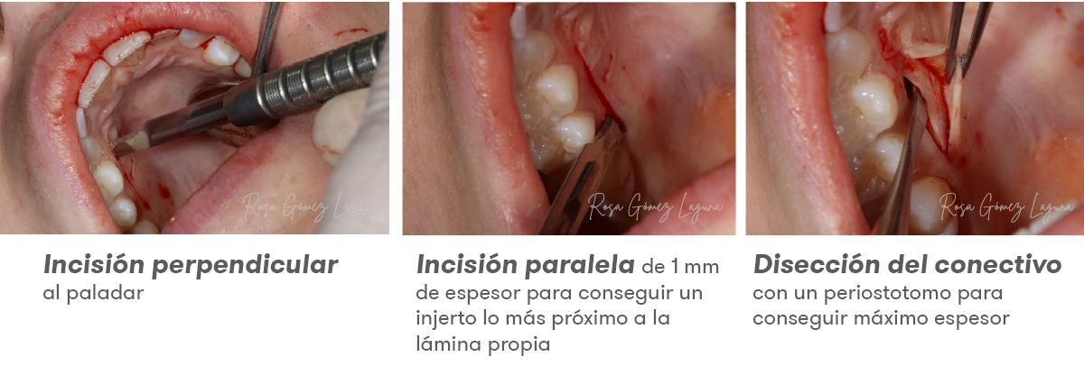 Imagem 5 do caso clínico de micro-acesso apical