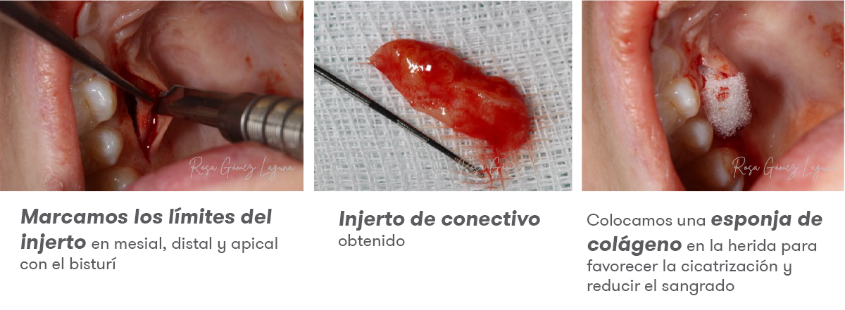 Imagem 6 do caso clínico de microacesso apical.