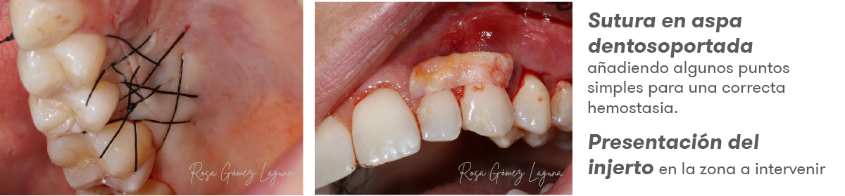 Imagem 7 do caso clínico de microacesso apical