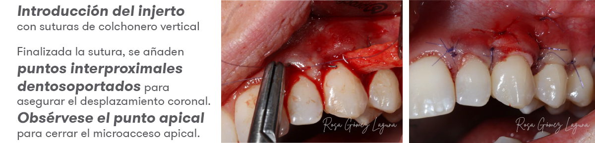 Imagem 8 do caso clínico de microacesso apical