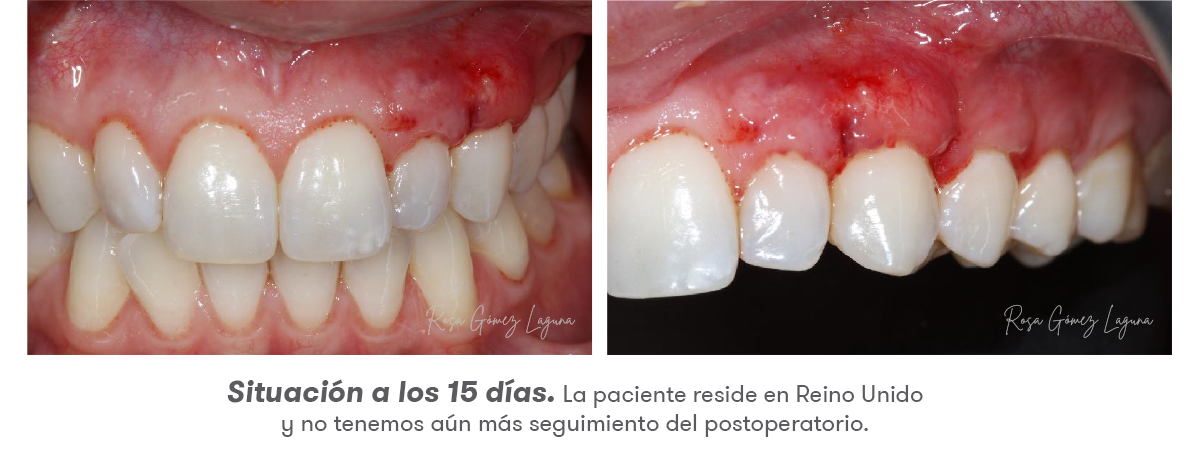 Imagem 9 do caso clínico de micro-acesso apical