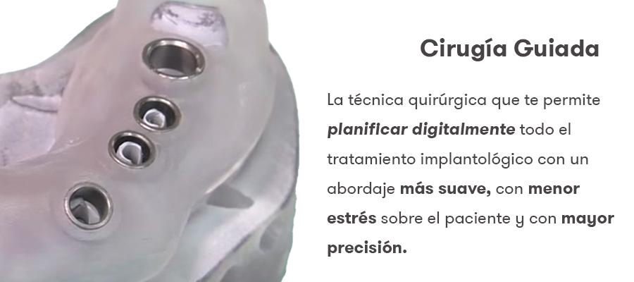 Cirurgia guiada com AlphaBio Tec e o implante MultiNeO CS