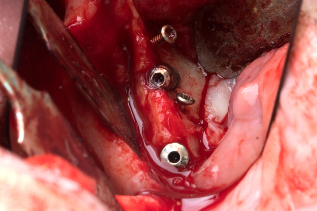 Técnica tent pole imagen 1