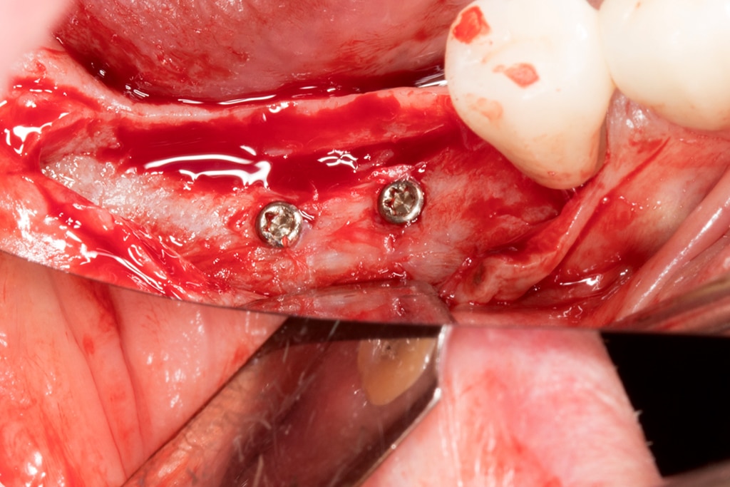 Técnica tent pole imagen 2