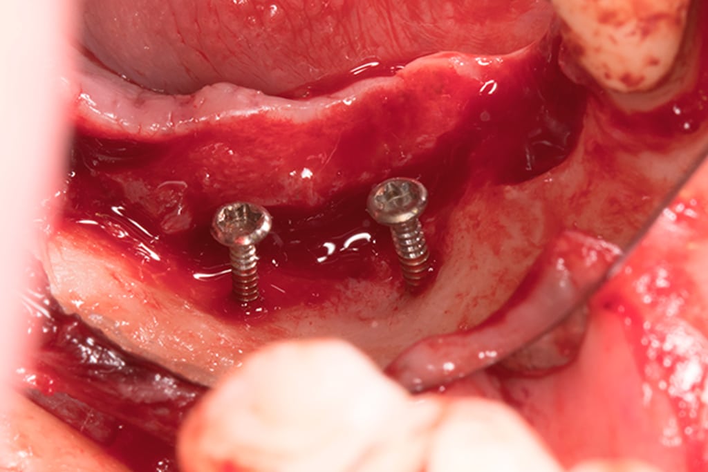 Técnica tent pole imagen 3