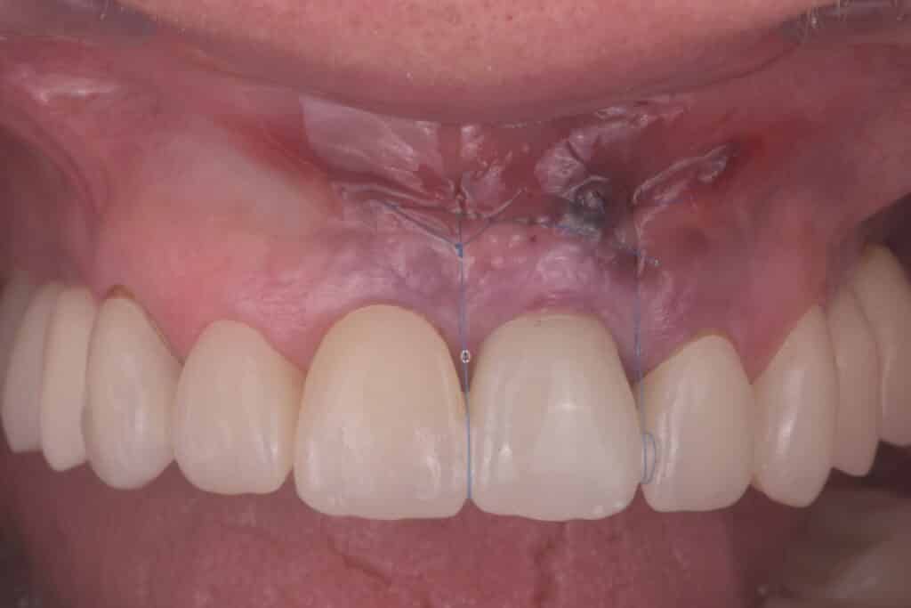 Caso clínico: tejidos blandos en implantología estética 1