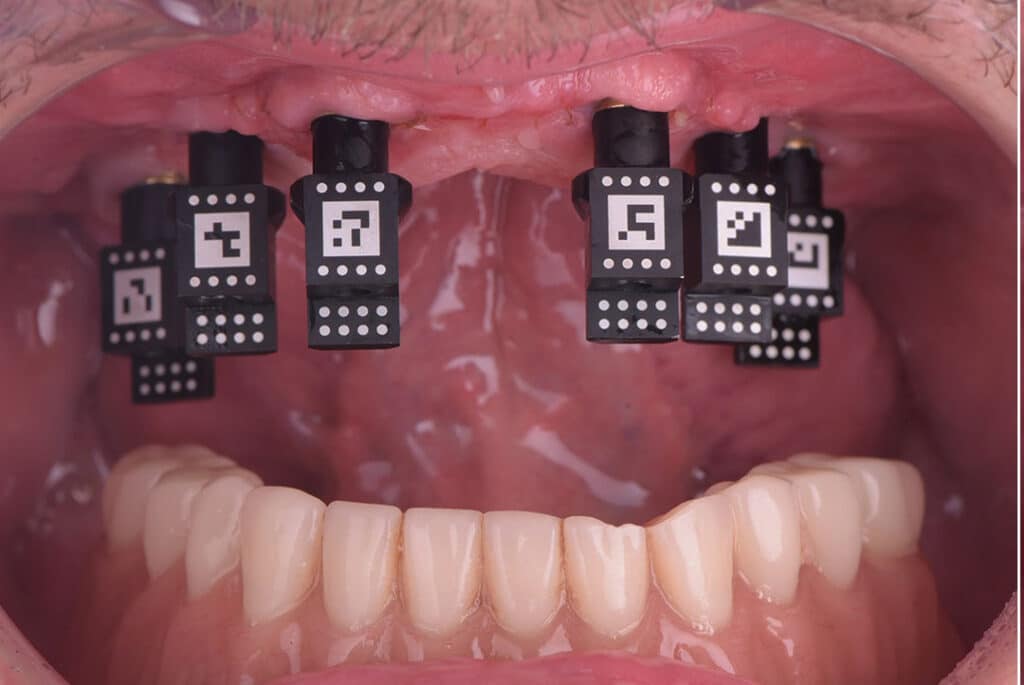 Caso clínico Álvaro Reuter Implantes Subperiósticos 1