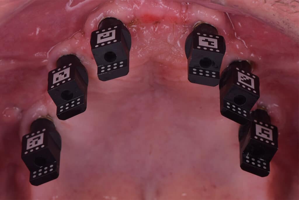 Caso clínico Álvaro Reuter Implantes Subperiósticos 2