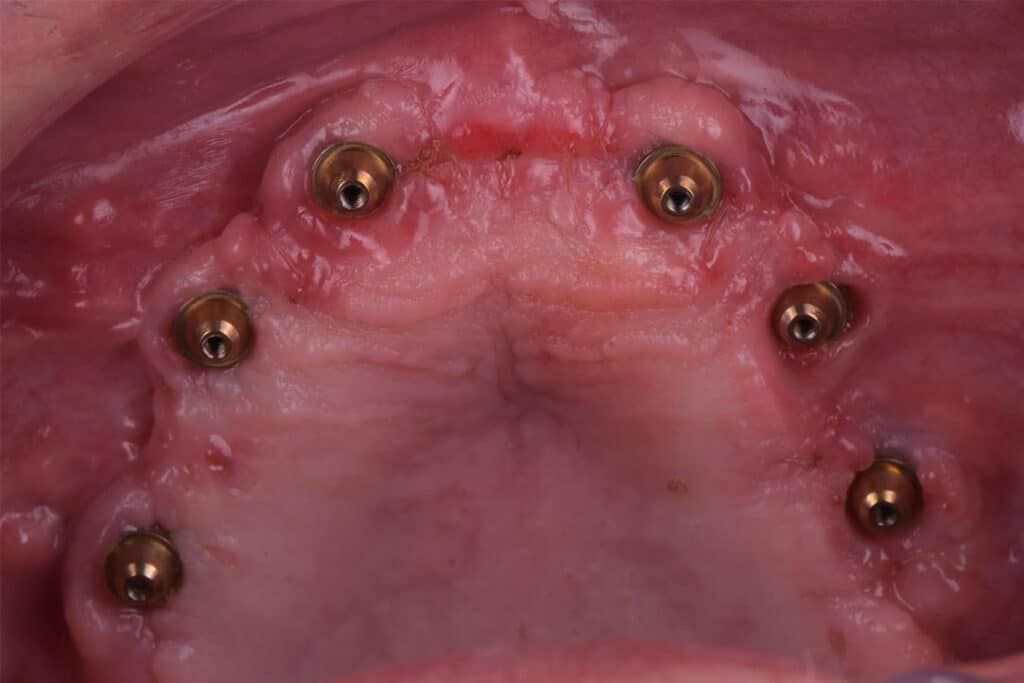 Caso clínico Álvaro Reuter Implantes Subperiósticos 3