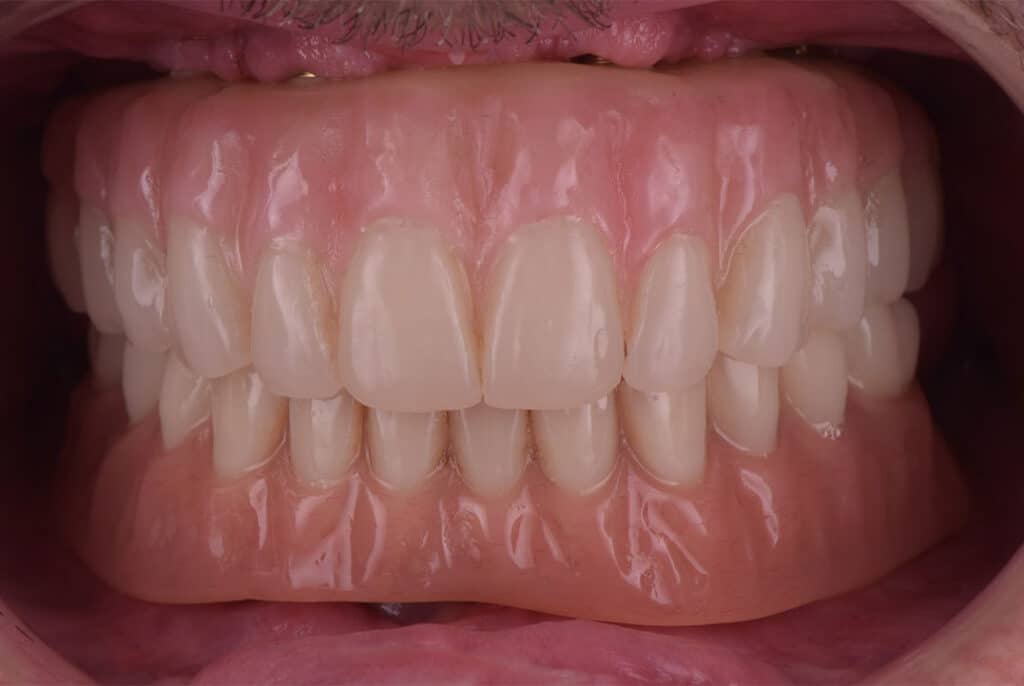 Caso clínico Álvaro Reuter Implantes Subperiósticos 4