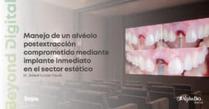 Caso clínico Dr. Ernest Lucas Taulé Implante inmediato en alveólo postextracción