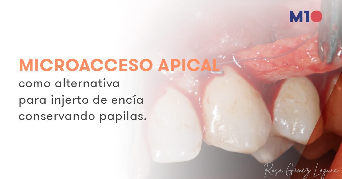 Estudio sobre el microacceso apical